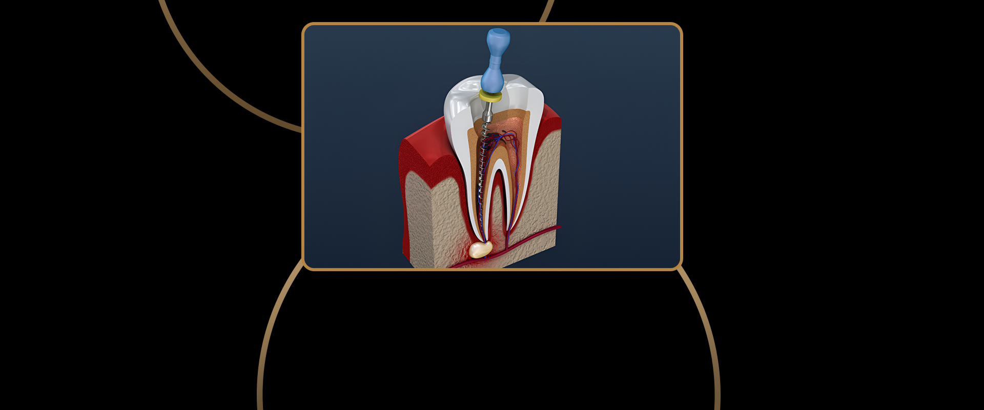 Root Canal
